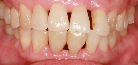 Receding Gums Are Irreversible! If You Feel Your "Gaps Are Growing," Stop These 5 Things Immediately