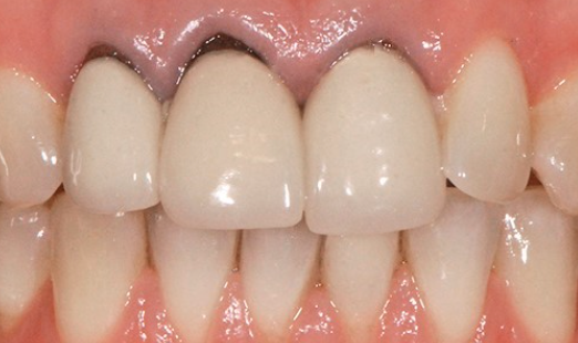 That Dark Line at Your Gumline: What Is It and Should You Worry?