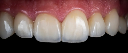 Help! Are Your Teeth Turning Transparent? The Shocking Truth You Need to Know Before It’s Too Late