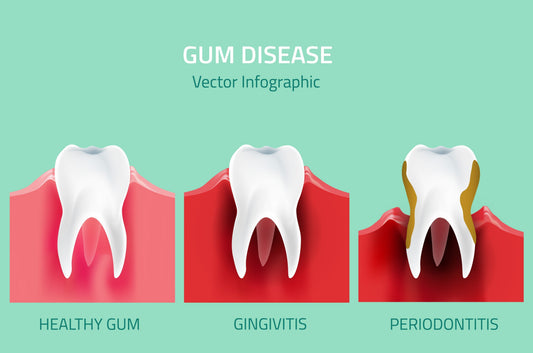 How to Prevent Gum Recession Naturally: 5 Dental Secrets to Save Your Smile